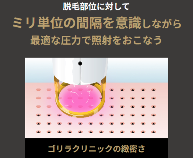 ゴリラクリニック_技術‗緻密さ