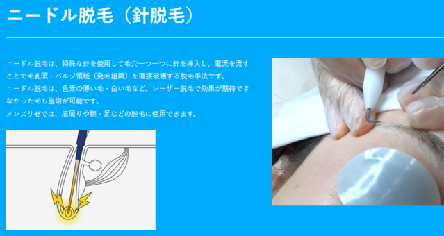 メンズリゼ_ニードル脱毛