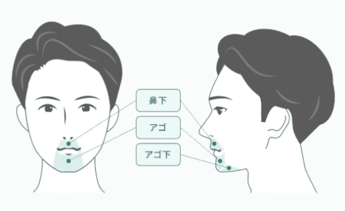 フレイアクリニックメンズ ヒゲ脱毛(3部位)
