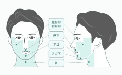 フレイアクリニックメンズ ヒゲ脱毛全部位