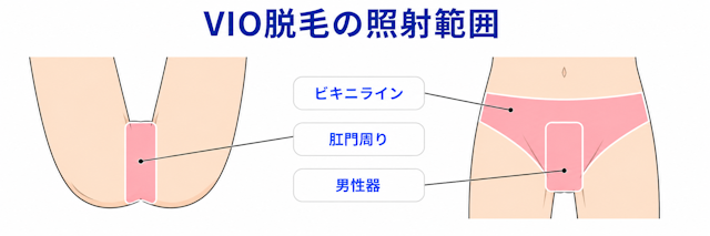 VIIO脱毛　照射範囲