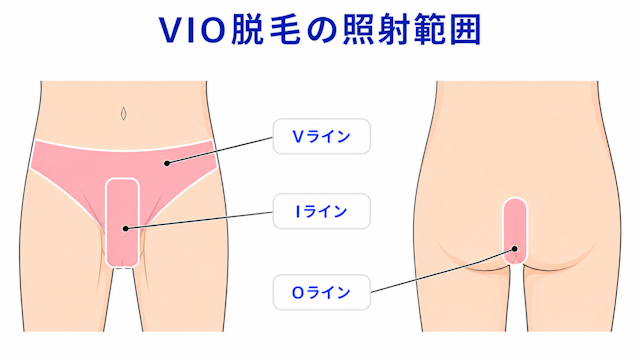 VIO脱毛　照射範囲　フレイヤクリニック　メンズ
