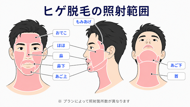 ヒゲ脱毛　照射範囲　エミナルクリニックメンズ