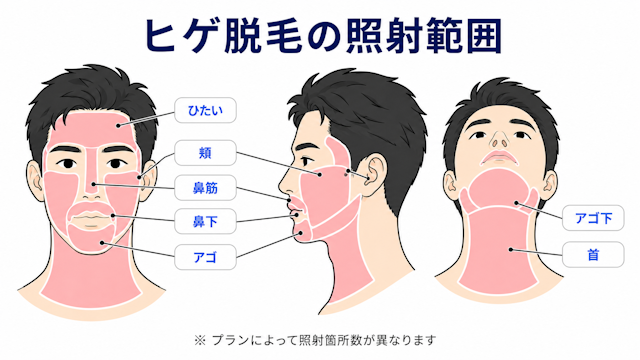 ヒゲ脱毛　照射範囲