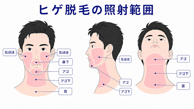 ヒゲ脱毛　照射範囲全方位　フレイヤクリニックメンズ