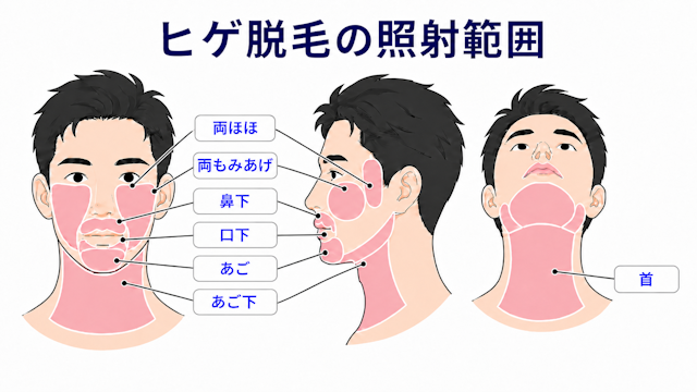 ヒゲ脱毛　照射範囲　RINX