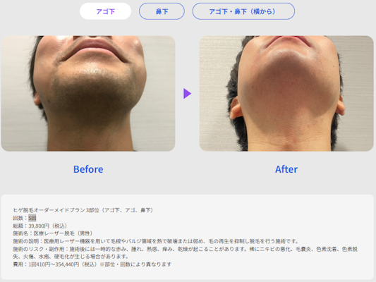 レジーナクリニックオムのヒゲ脱毛ビフォアフター
