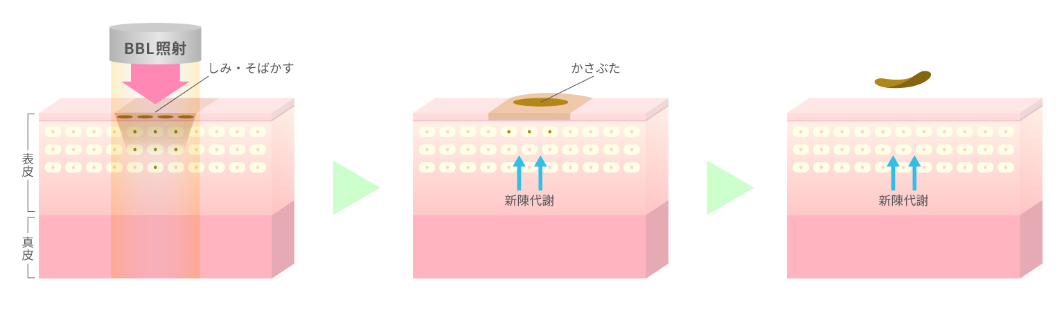 BBLフェイシャル｜シミ・美肌・ニキビ・毛穴・たるみ・肌質改善