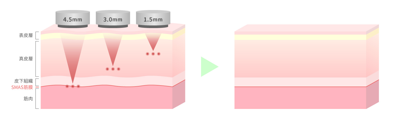 HIFU｜たるみ・小顔・シワ・くま