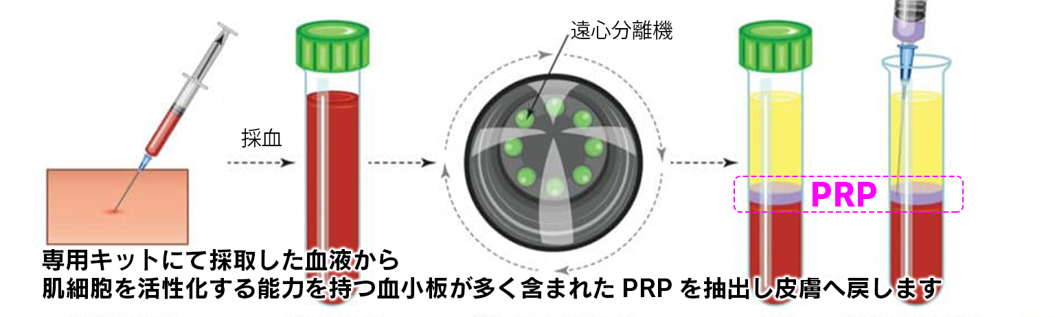 PRP｜目元のたるみ・くま・小じわ