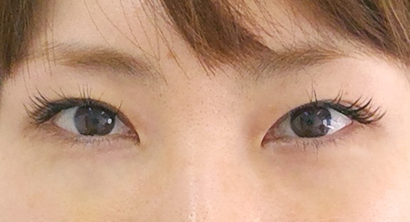 下眼瞼脱脂｜目元のたるみ・くま