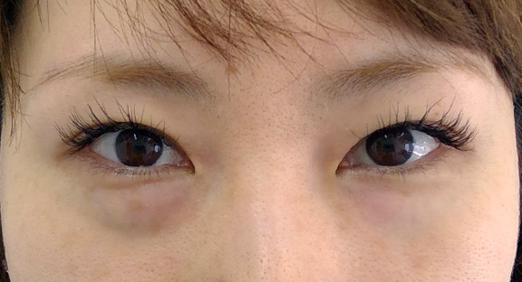 下眼瞼脱脂｜目元のたるみ・くま