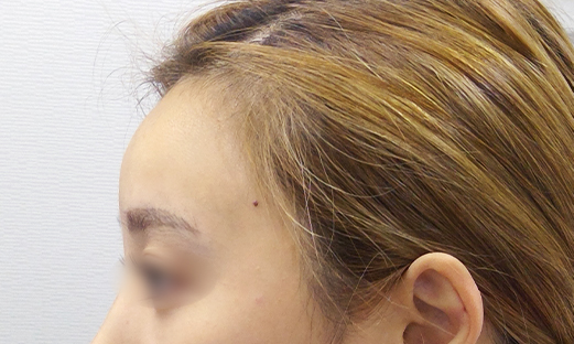 ヒアルロン酸注射｜しわ・たるみ・毛穴・美肌