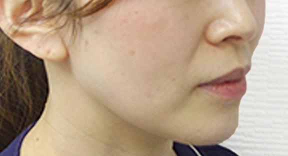 糸リフト｜しわ・小顔・シミ