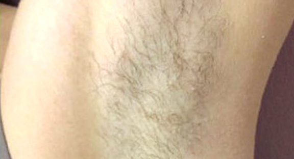 医療レーザー脱毛(女性)｜女性脱毛