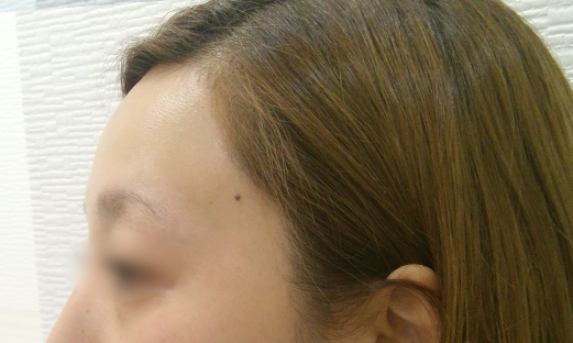 ヒアルロン酸注射｜しわ・たるみ・毛穴・美肌