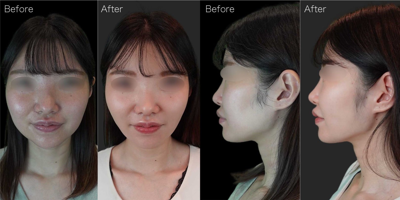 脂肪吸引｜たるみ・痩身