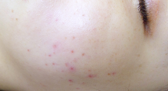 レーザートーニング｜シミ・美肌・ニキビ・毛穴・肌質改善