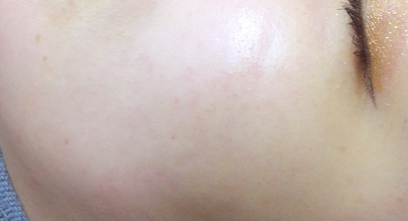 レーザートーニング｜シミ・美肌・ニキビ・毛穴・肌質改善