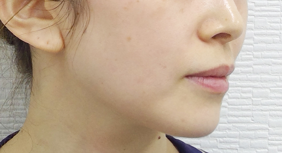 糸リフト｜しわ・小顔・シミ