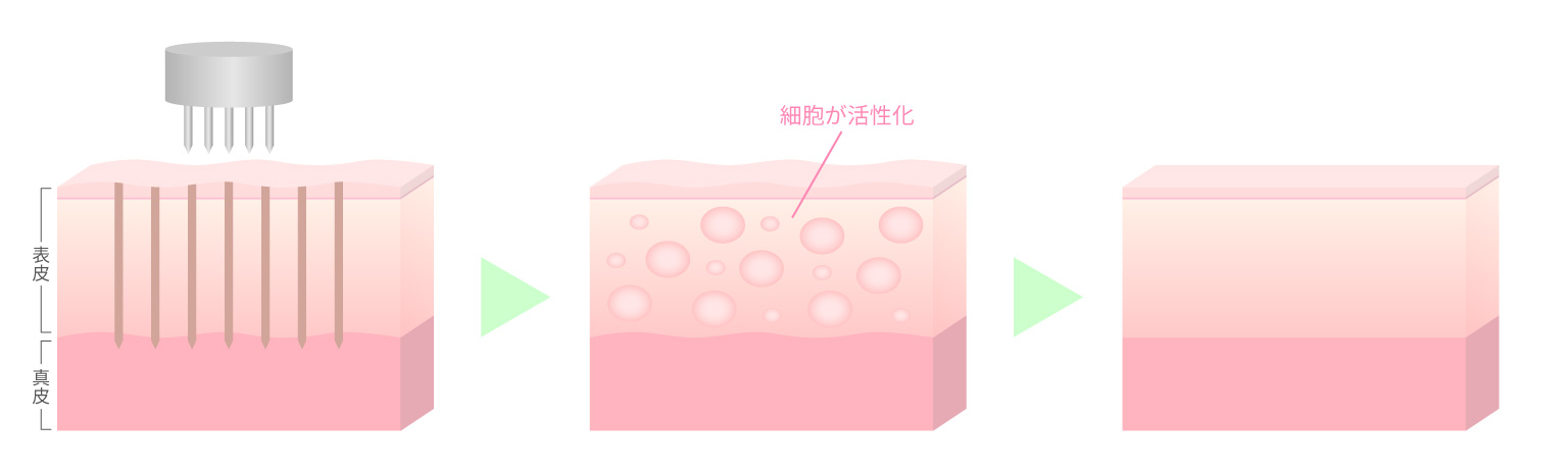 ダーマペン｜美肌・ニキビ・毛穴・肌質改善