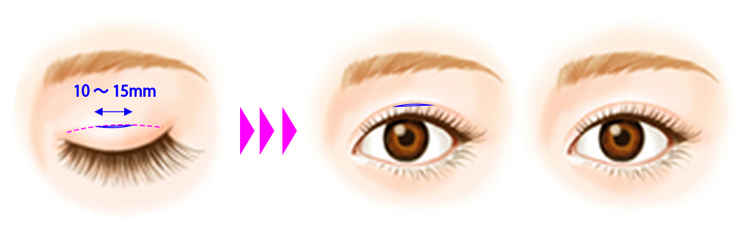 二重埋没法｜二重まぶた